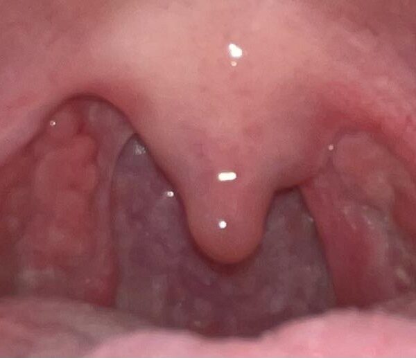 can tonsils grow back after being removed? - tymoff