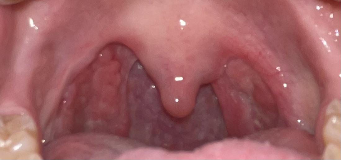 can tonsils grow back after being removed? - tymoff